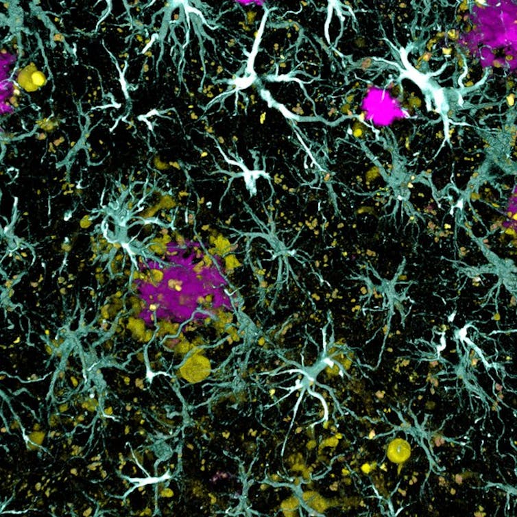 Plaques amyloïdes dans le cerveau de patients atteints de la maladie d’Alzheimer