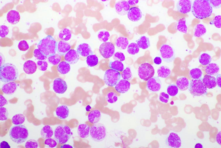 Image en microscopie de leucémie aiguë promyélocytaire 