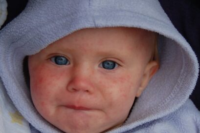 Visage d'enfant avec boutons dûs à la rougeole.