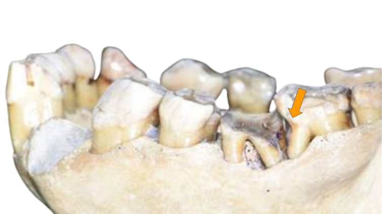 Mâchoire d’orang-outan présentant une dentition complète, dont une dent porte une rainure inhabituelle à la base de sa racine