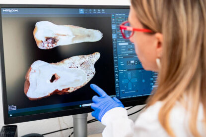 Une scientifique observe une molaire d’une femme du Néolithique au microscope numérique.