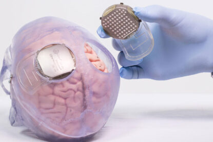 Implant Wimagine par Clinatec