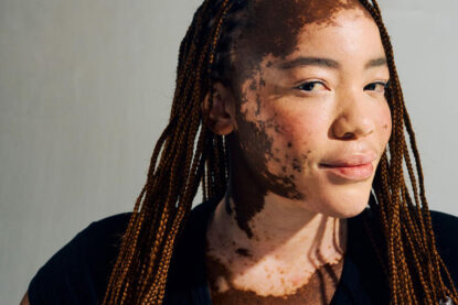 Une jeune femme ayant un vitiligo, maladie auto-immune.