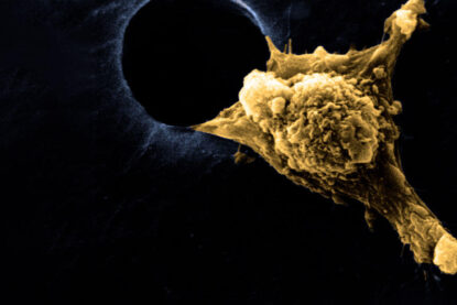 Image de microscopie d’une cellule métastasique et ses pseudopodes